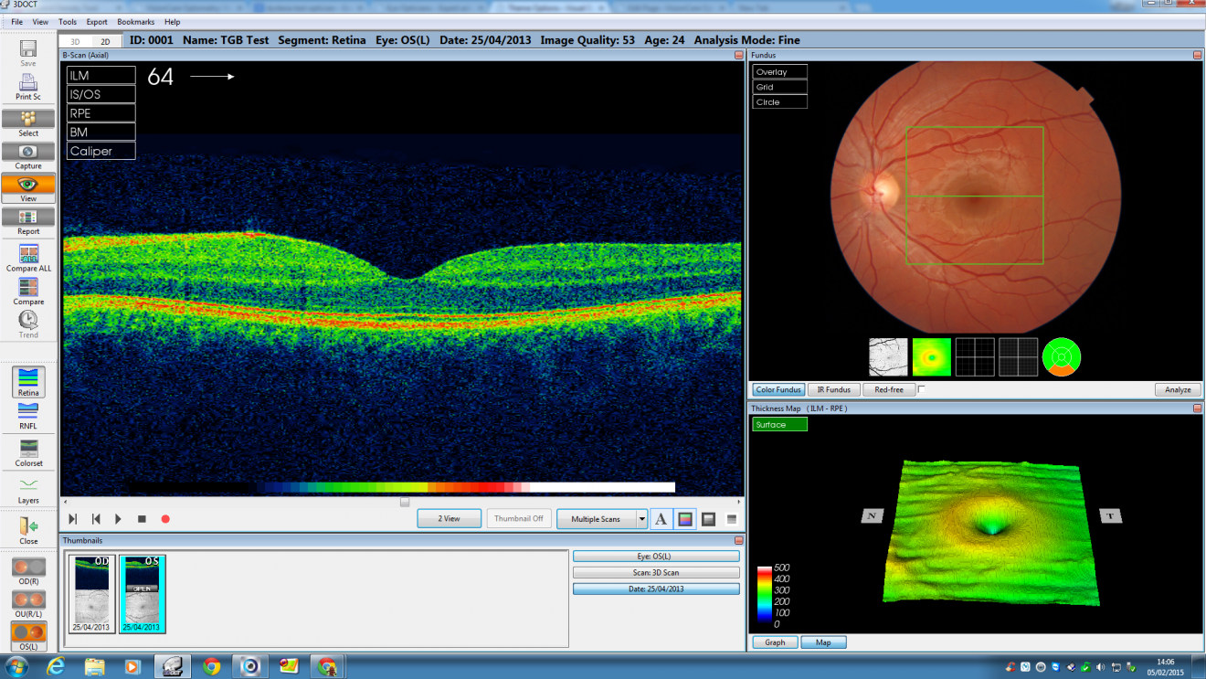 Visioncare 3d Optical Coherence Tomographer