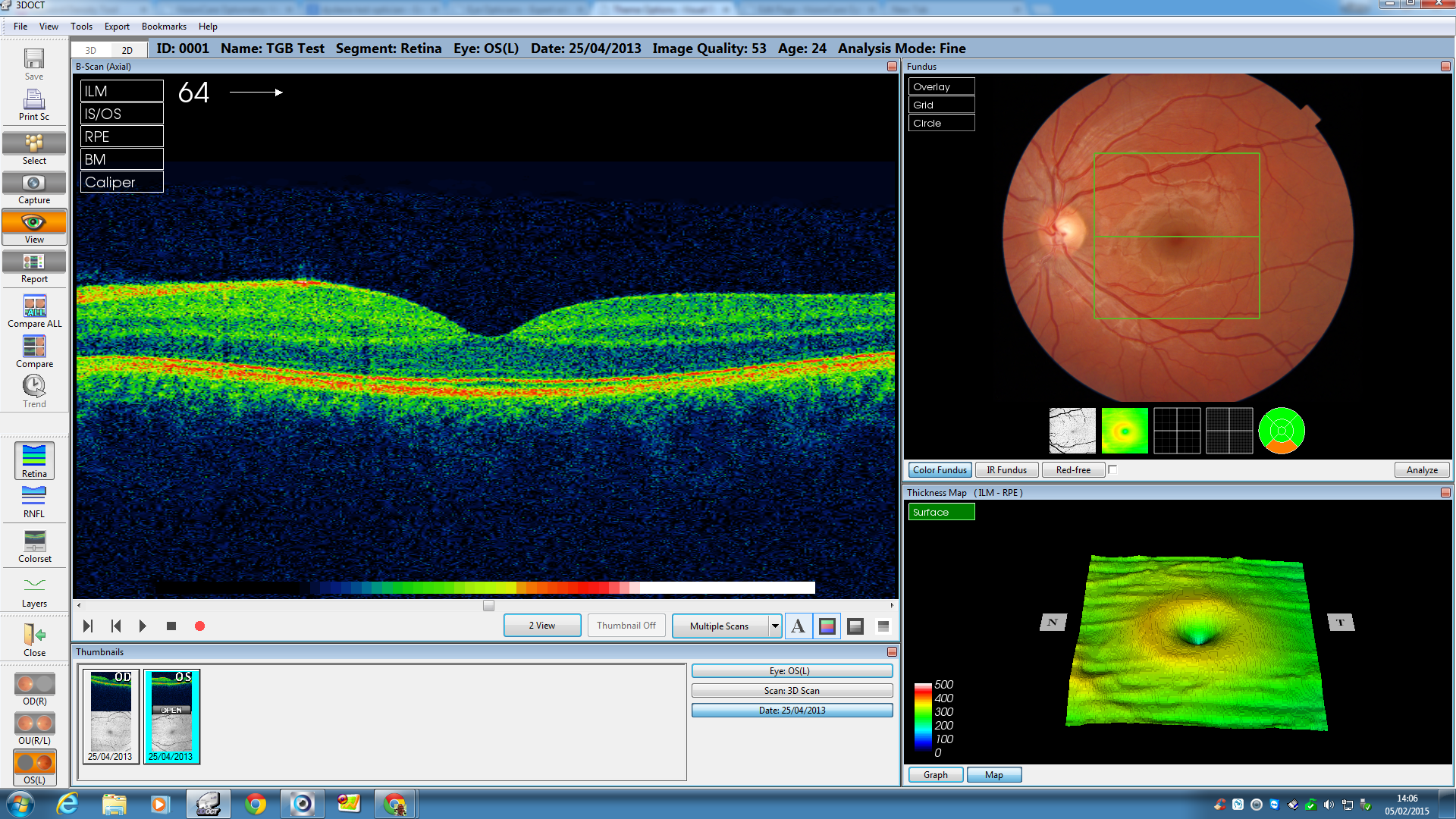 3d OCT Optical Coherence Tomography - Opticians in CastlefordVisionCare