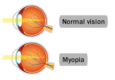 myopia probléma)