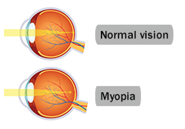 Rövidlátás (myopia)